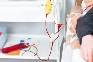 Плазмаферез