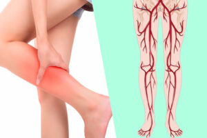 Лечение заболеваний периферических артерий в Германии