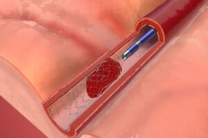 Хирургическое лечение