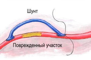 лечение мезентериальной ишемии