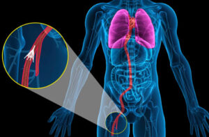лечение тромбоза