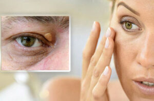 удаление ксантелазмы