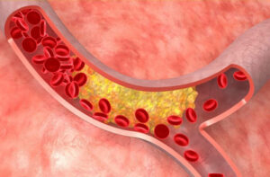 закупорка сосудов