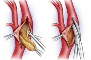лечение закупорки сосудов