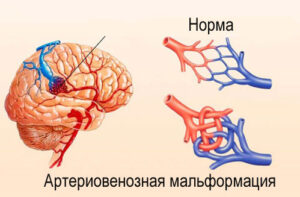 артериовенозная мальформация