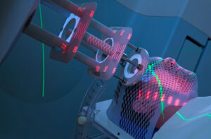 лечение артериовенознлй мальформации