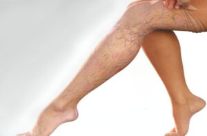 тромбоз глубоких вен