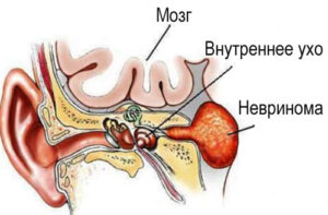 невринома
