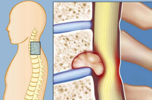остеобластома позвоночника