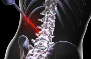 лечение остеобластомы позвоночника