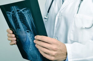 лечение сколиоза позвоночника