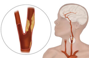стеноз сонной артерии