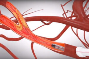 лечение стеноза сонной артерии