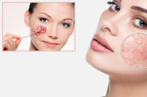 удаление сосудистых звездочек на лице