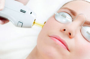 удаление сосудистых звездочек на лице