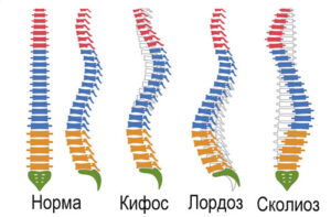 искривление позвоночника