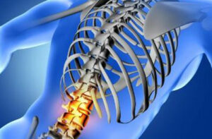 хондросаркома позвоночника