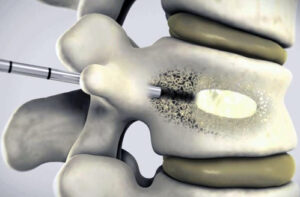 лечение остеохондромы позвоночника