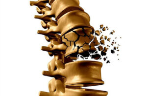 перелом позвоночника