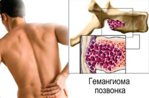 гемангиома позвоночника