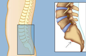 хордома позвоночника