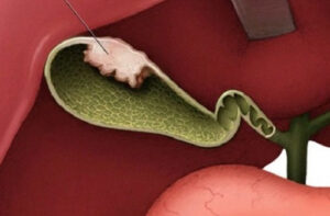 киста желчного пузыря