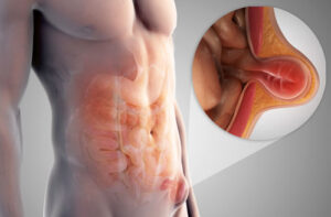 паховая грыжа