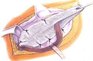 Лечение паховой грыжи