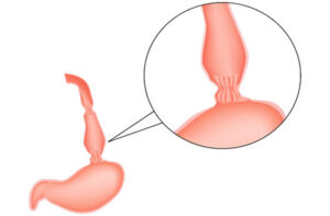 ахалазия кардии пищевода