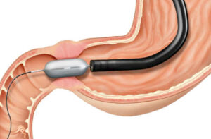 лечение ахалазии кардии пищевода