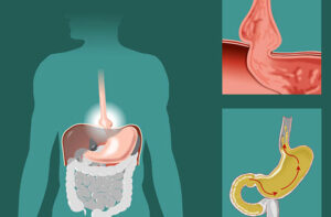 диафрагмальная грыжа
