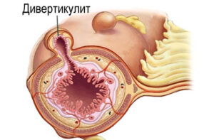 дивертикулит пищевода