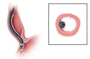 лечение дивертикулита пищевода
