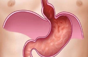 грыжа пищеводного отверстия диафрагмы