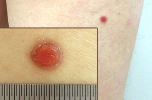 злокачественная эккринная порома