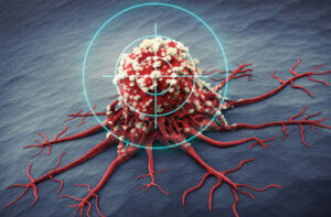 лечение злокачественной эккринной поромы