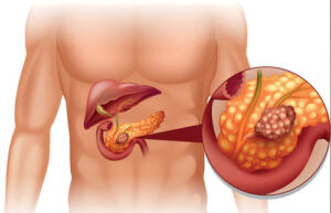 киста поджелудочной железы