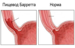 пищевод Барретта