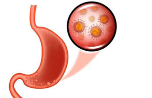 полипы желудка