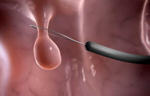 лечение полипов желудка