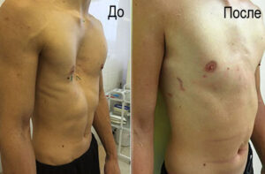 воронкообразная деформация грудной клетки