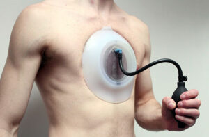 Лечение воронкообразной деформации грудной клетки