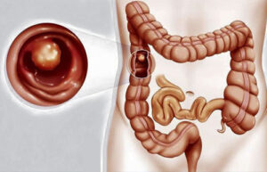 полипоз кишечника