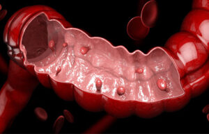 полипоз прямой кишки