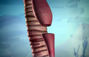 атрезия пищевода