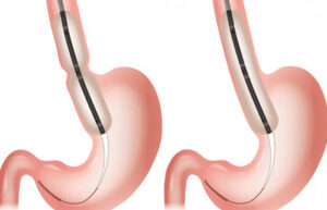 лечение атрезии пищевода