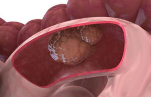 опухоль тонкого кишечника