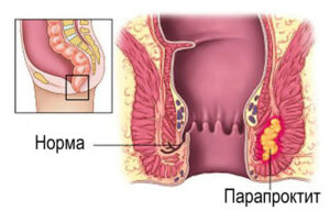 парапроктит