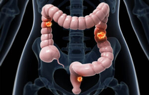 рак ободочной кишки