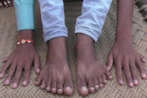 Лечение полидактилии в Германии